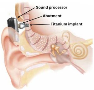 Illustration showing bone conductive device