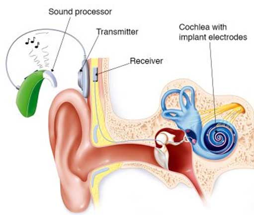 Cochlear implant diagram